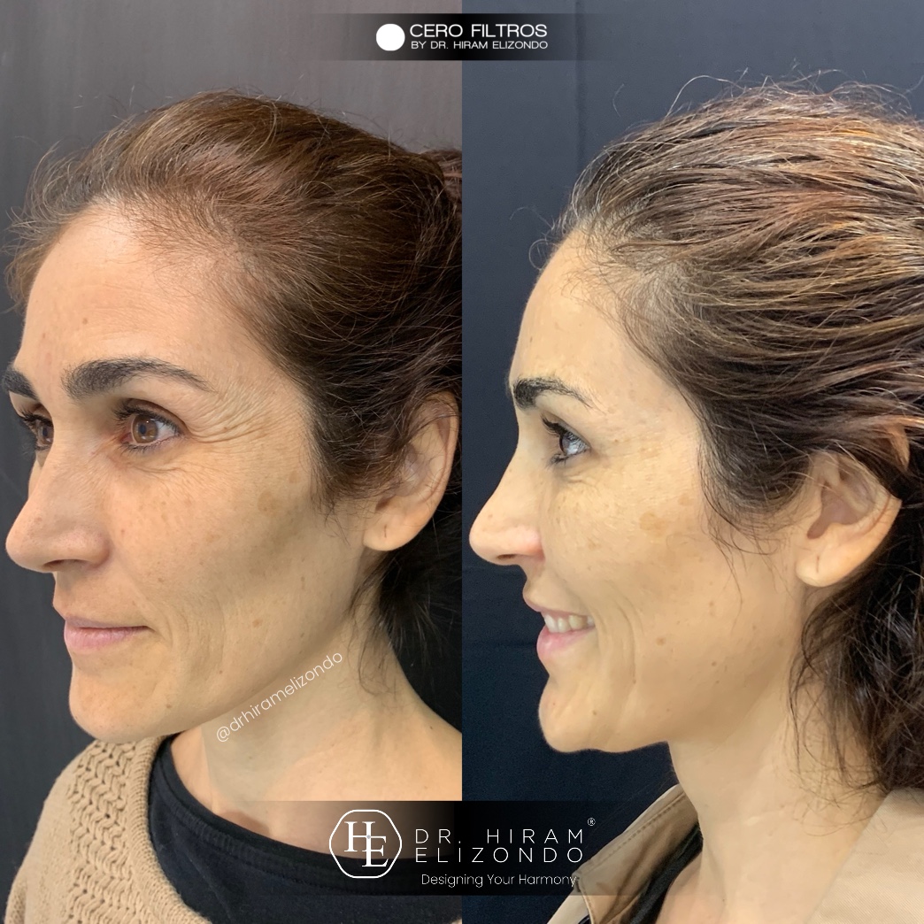 Dr-Hiram-Elizondo-Toxina-Botulinica-10