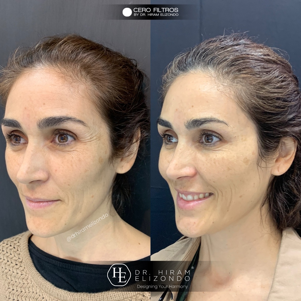 Dr-Hiram-Elizondo-Toxina-Botulinica-11