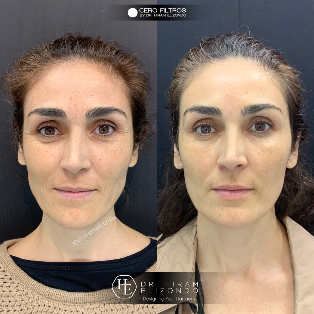 Dr-Hiram-Elizondo-Toxina-Botulinica-12