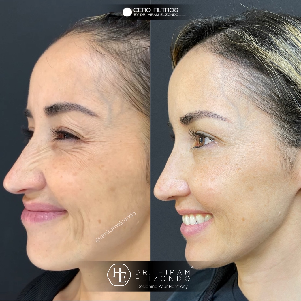 Dr-Hiram-Elizondo-Toxina-Botulinica-13