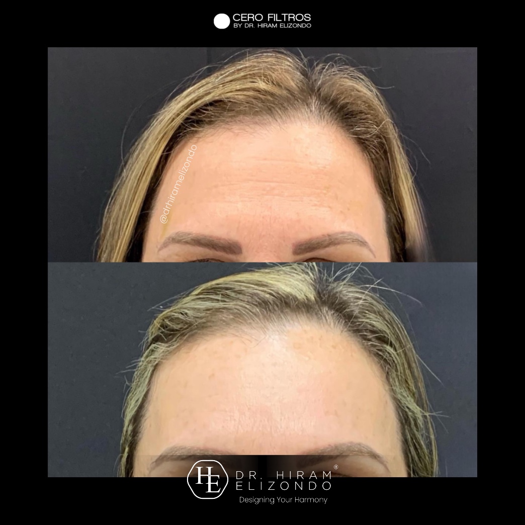 Hidrolifting Tratamiento