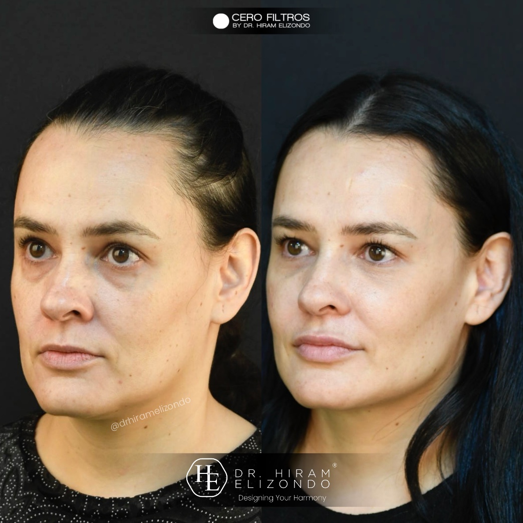 Relleno de Pómulos con Ácido Hialurónico Relleno de Pómulos con Ácido Hialurónico