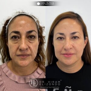 Bolsas debajo de los ojos - Síntomas y causas