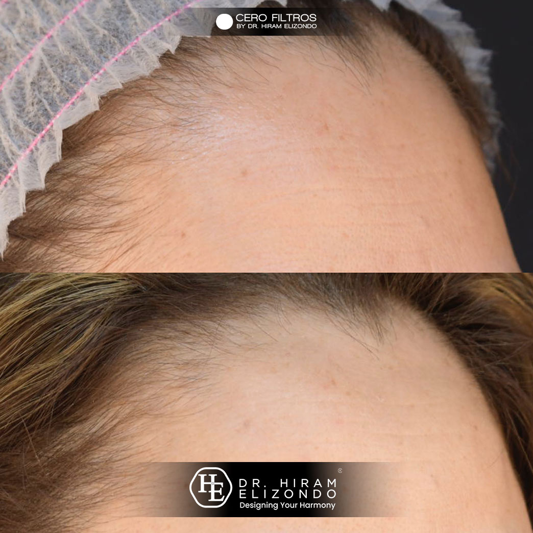 Dr-Hiram-Elizondo-Hidrolifting-1