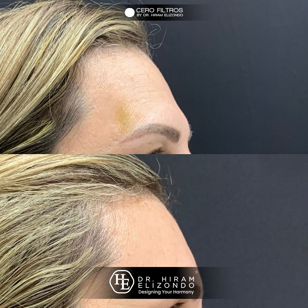 Dr-Hiram-Elizondo-Hidrolifting-2