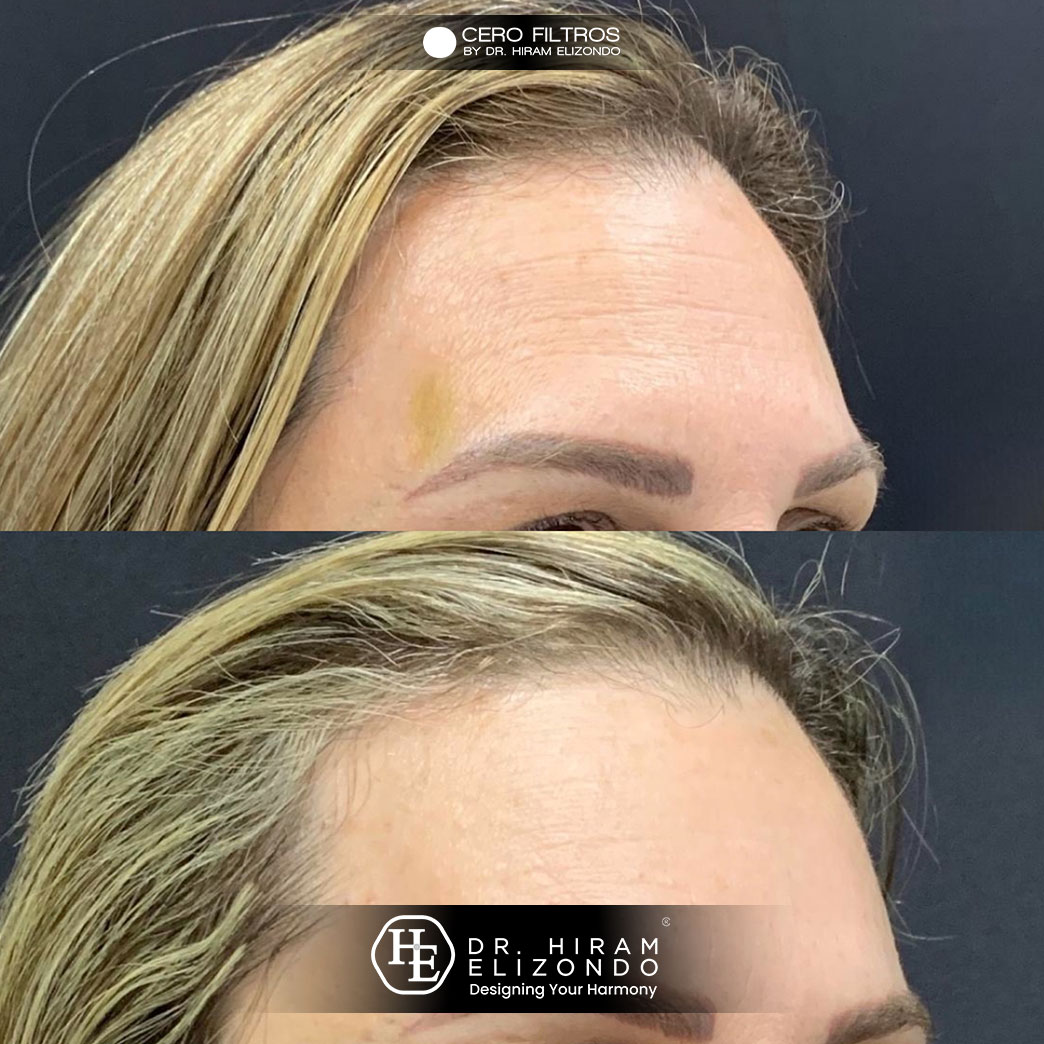 Dr-Hiram-Elizondo-Hidrolifting-3