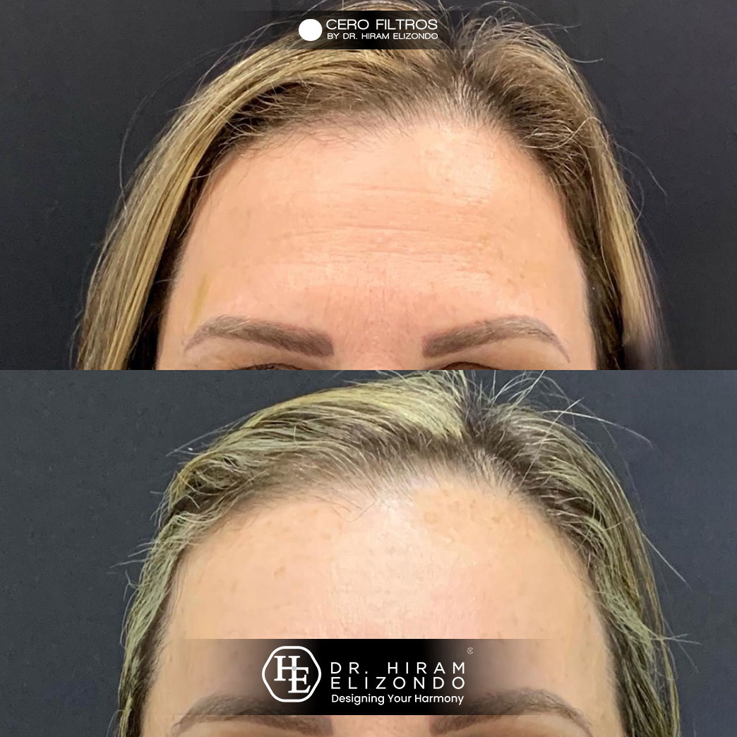 Dr-Hiram-Elizondo-Hidrolifting-4