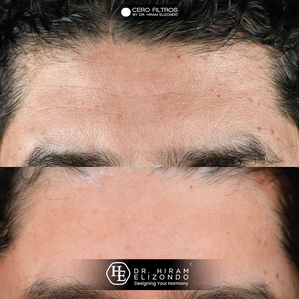 Dr-Hiram-Elizondo-Hidrolifting-5