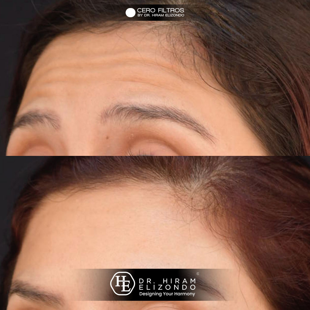 Dr-Hiram-Elizondo-Toxina-Botulinica-5