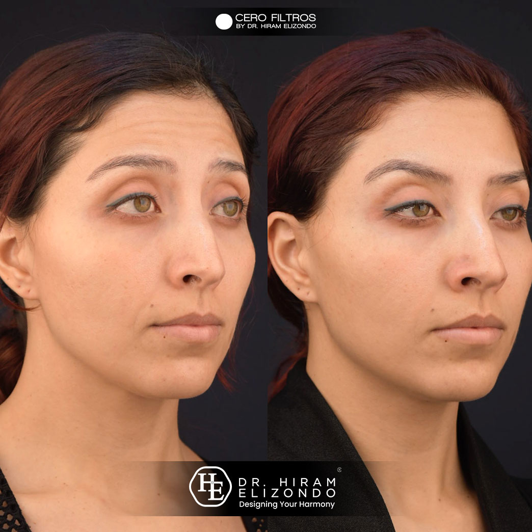 Dr-Hiram-Elizondo-Toxina-Botulinica-6