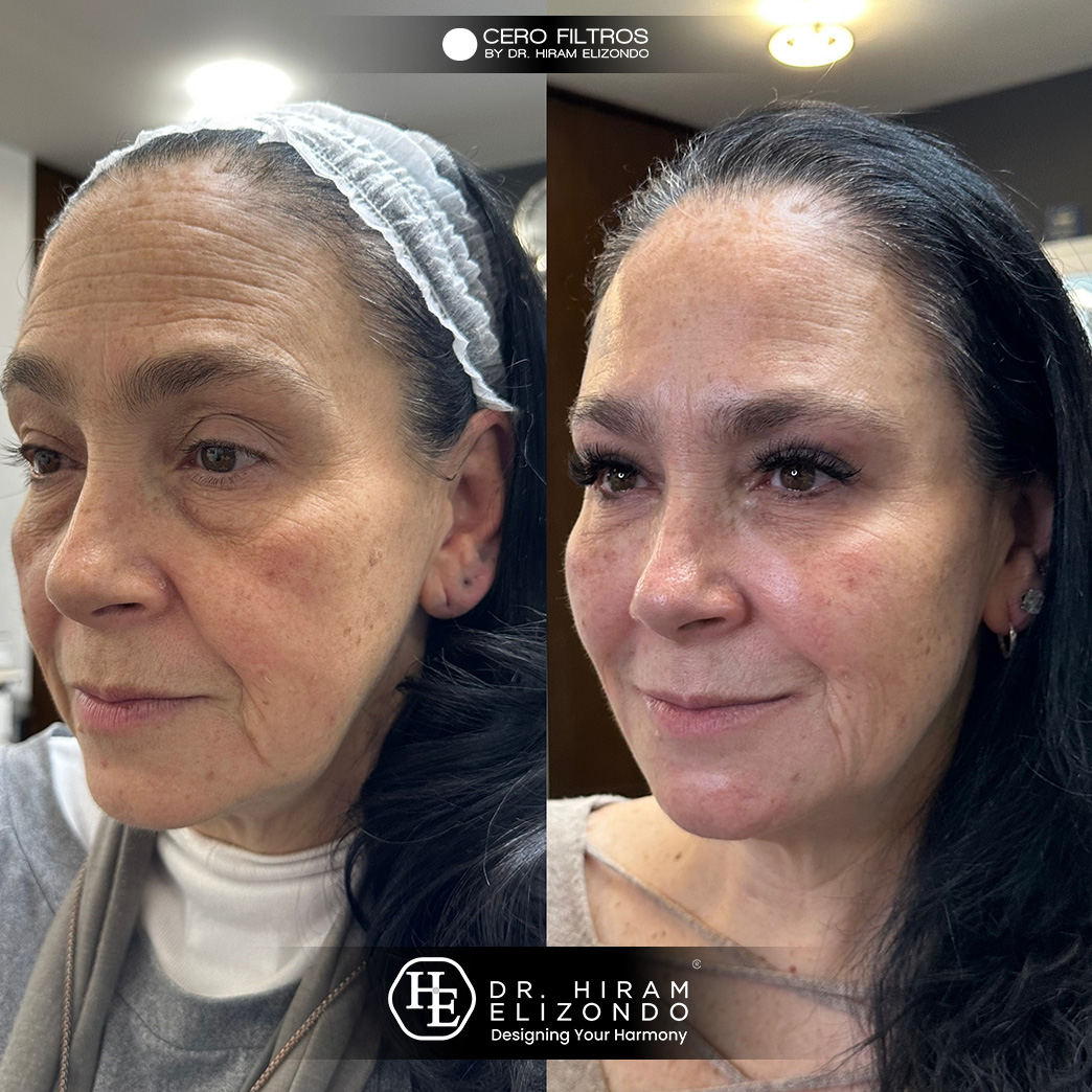 Dr-Hiram-Elizondo-ceja2