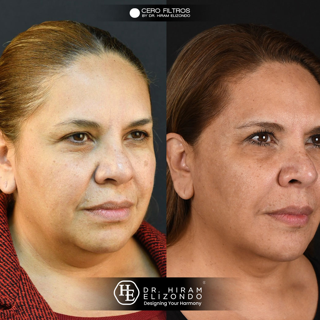 Dr-Hiram-Elizondo-cuello-1