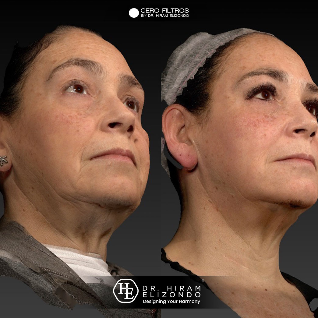 Dr-Hiram-Elizondo-cuello-2