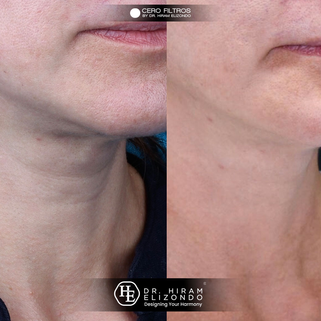 Dr-Hiram-Elizondo-cuello-3