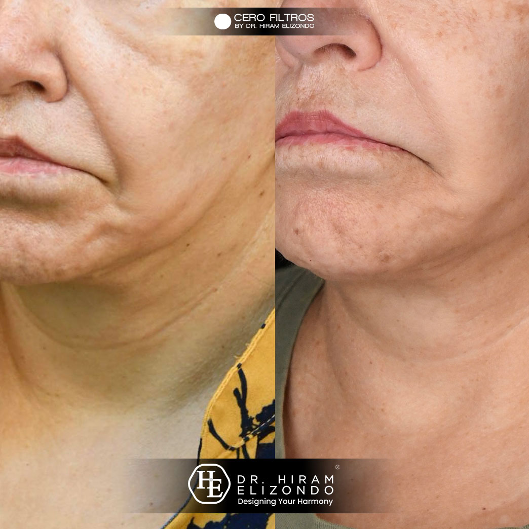 Dr-Hiram-Elizondo-cuello-4