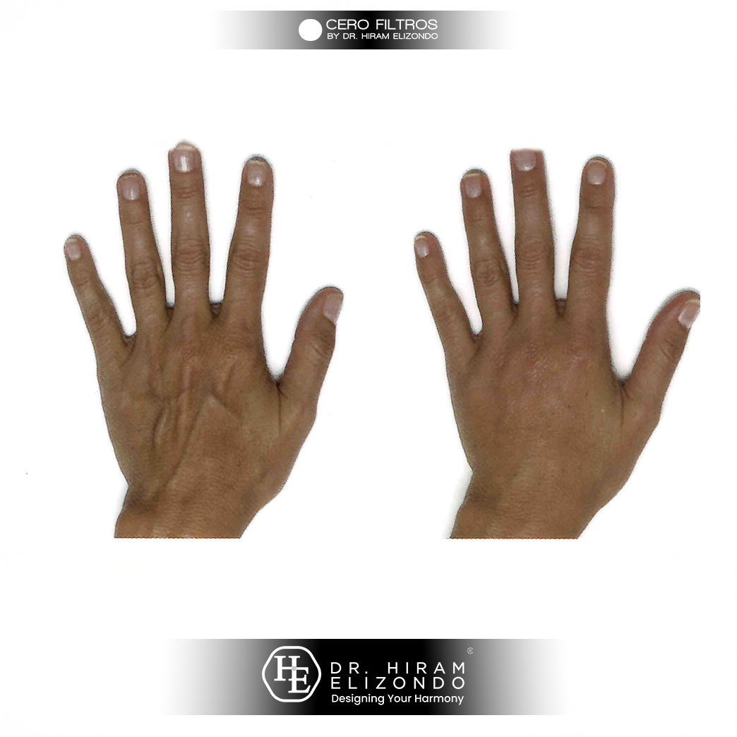 Dr-Hiram-Elizondo-manos-2