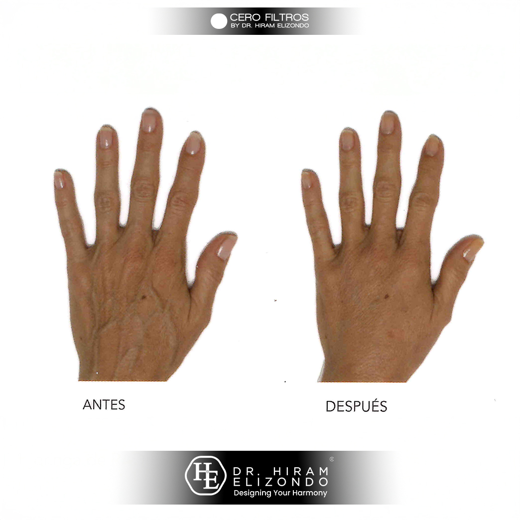 Dr-Hiram-Elizondo-manos-3