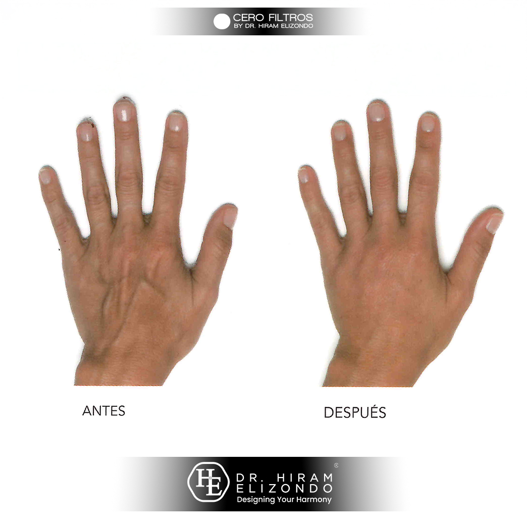 Dr-Hiram-Elizondo-manos-4